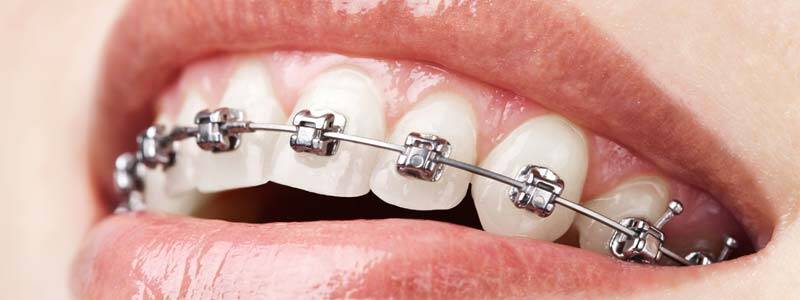 Traditional Braces