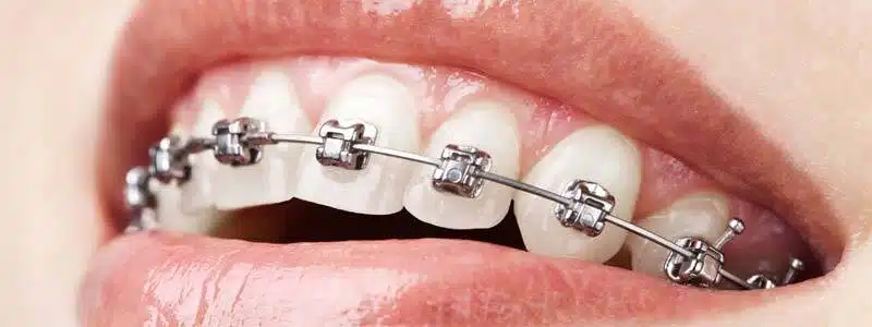 Traditional Braces