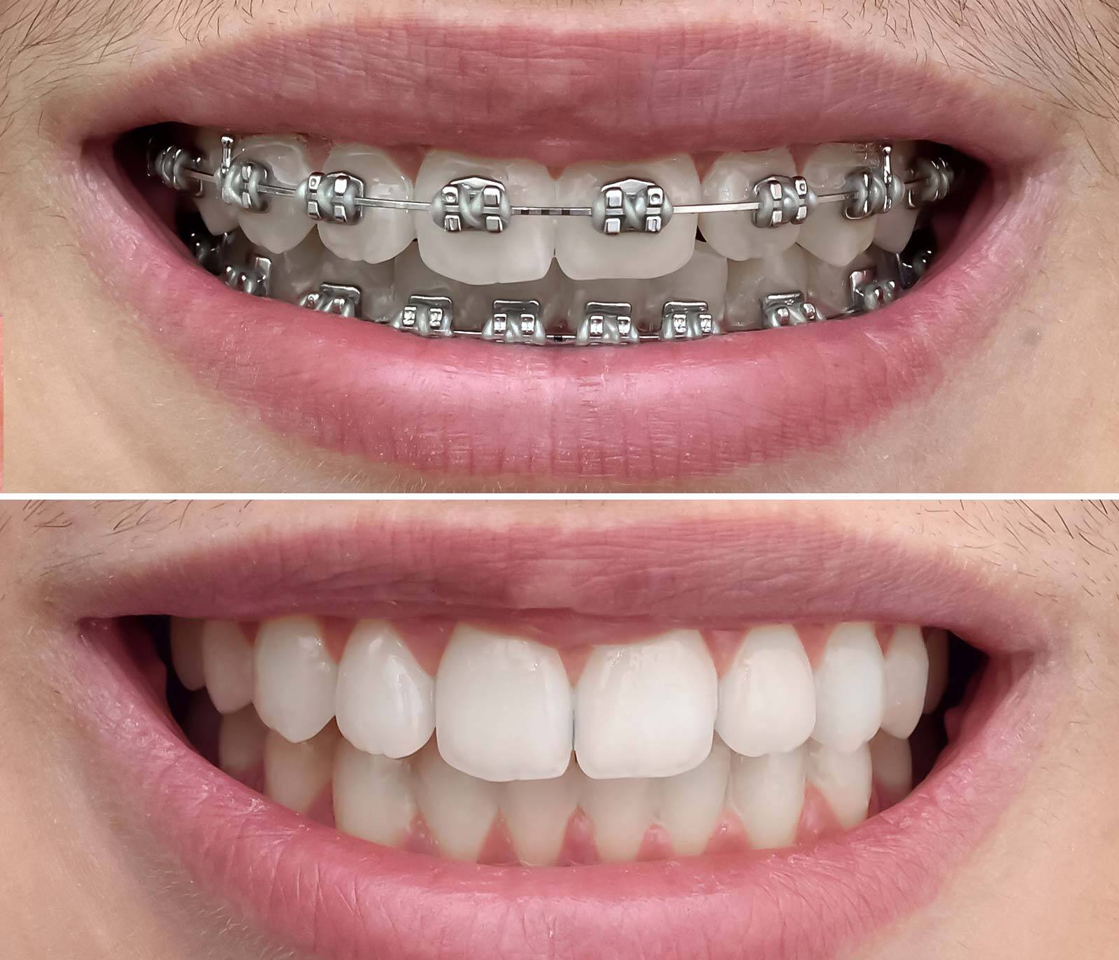 Traditional Braces Amazing Smiles