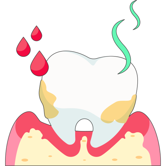 Advanced Periodontitis