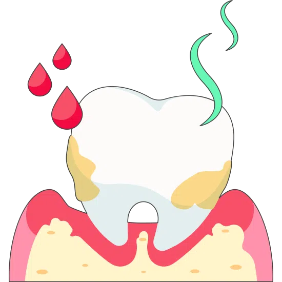 Advanced Periodontitis