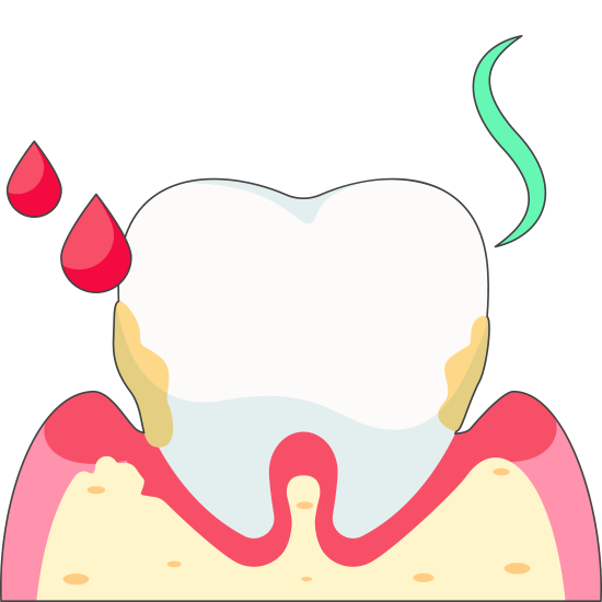 Moderate Periodontitis