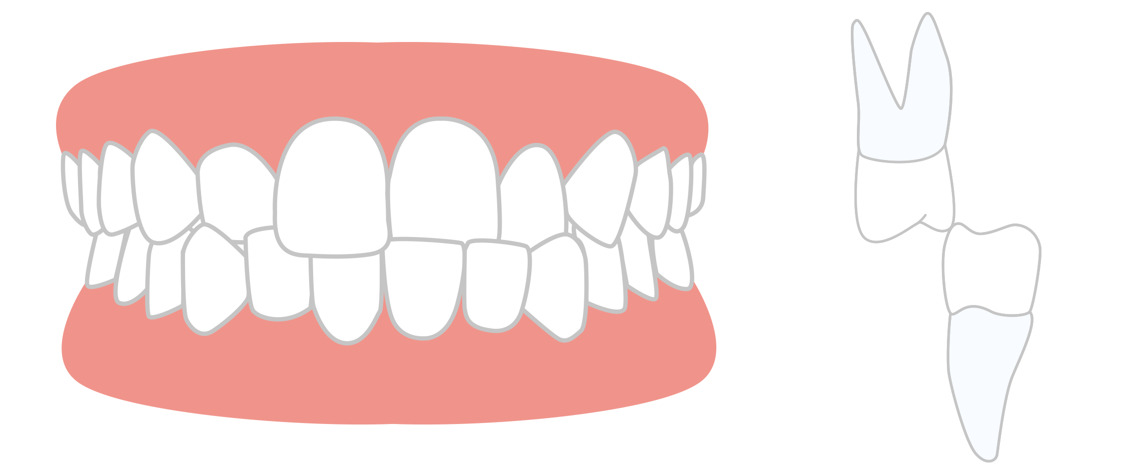 Cross Bite