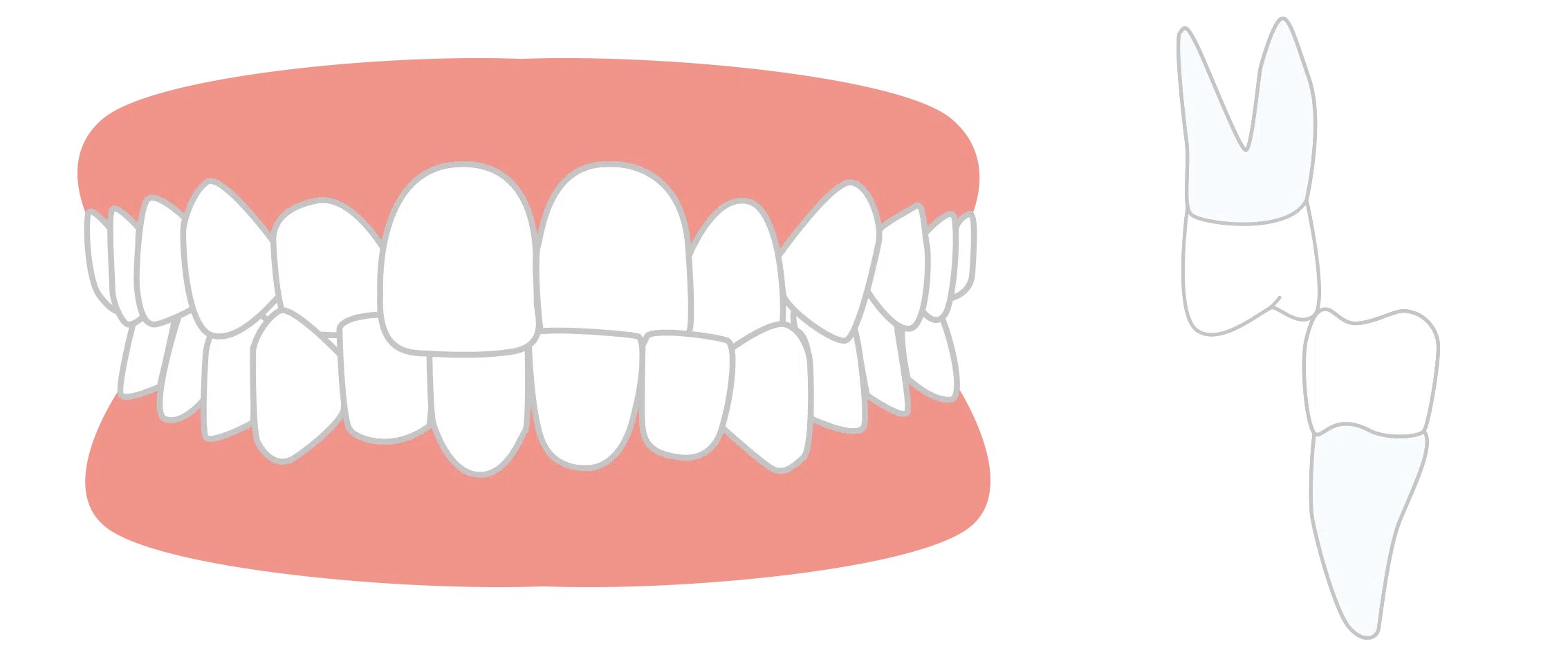 Cross Bite