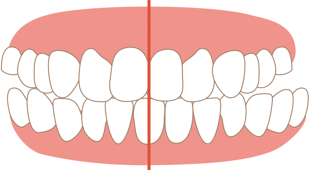 Crossbite