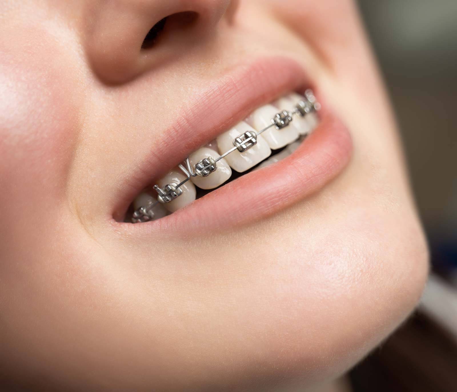 dental braces Amazing Smiles