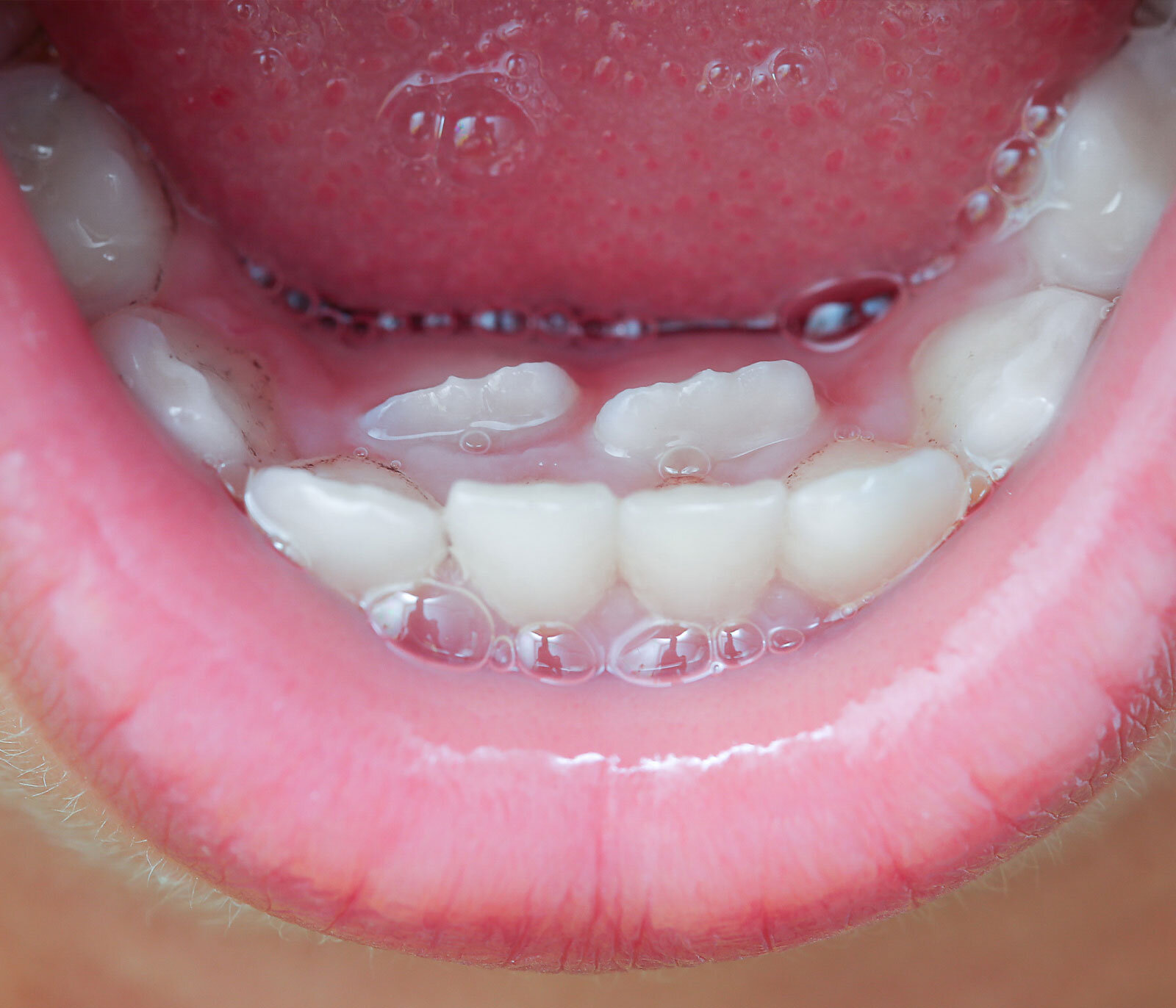 shark teeth in kids - Amazing Smiles