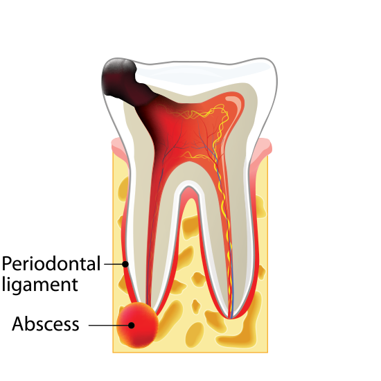 Stage Four Tooth Decay