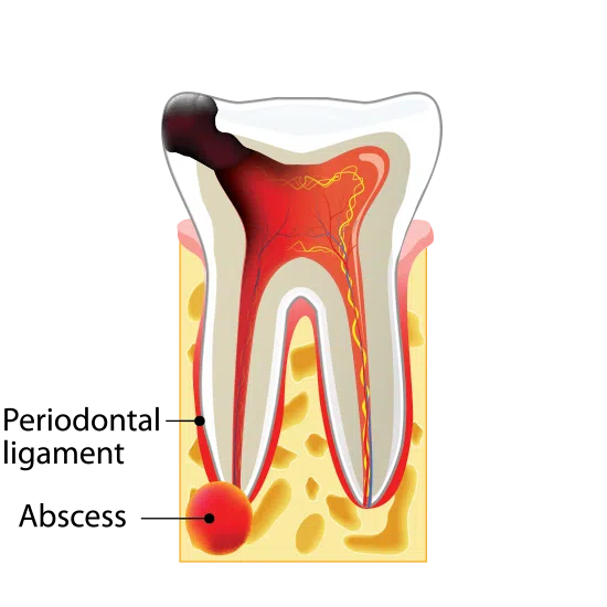 Stage Four Tooth Decay