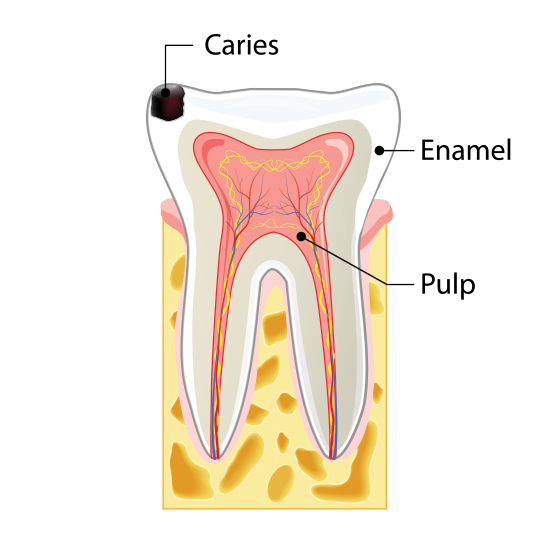 Stage One Tooth Decay