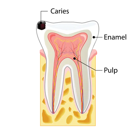 Stage One Tooth Decay