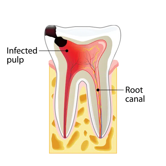 Stage Three Tooth Decay