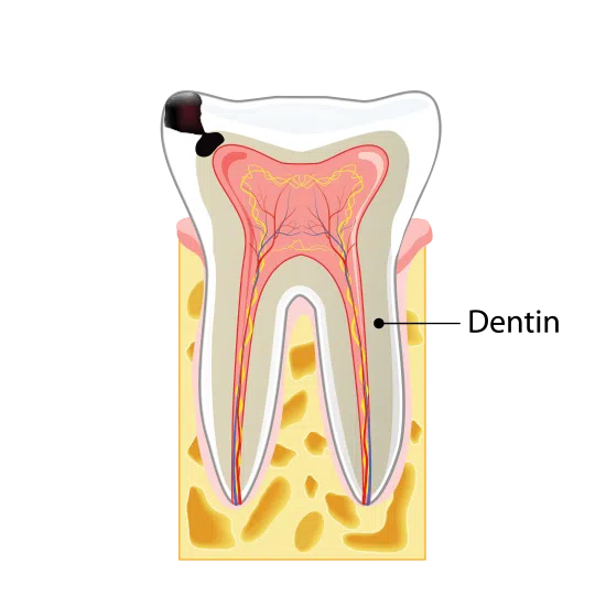 Stage Two Tooth Decay