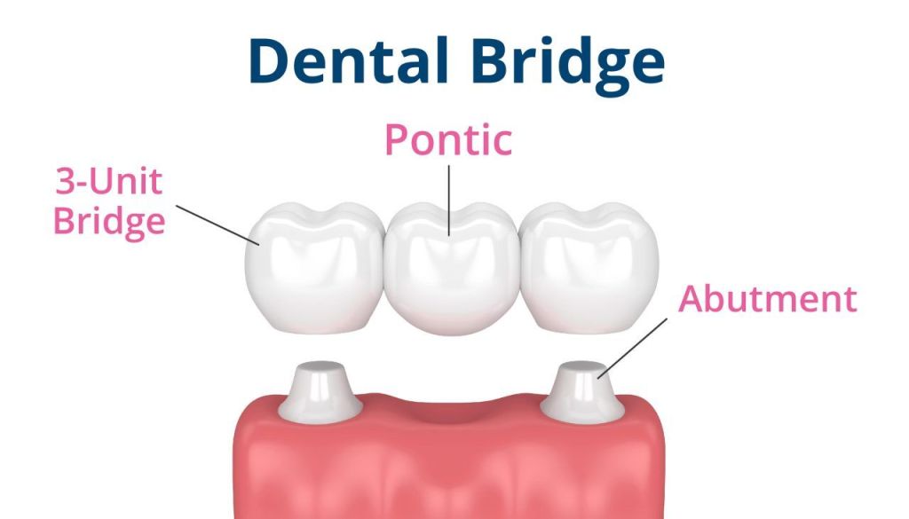 Dental Bridges For Replacing Missing Teeth Amazing Smiles