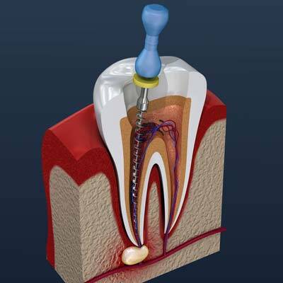 Endodontics