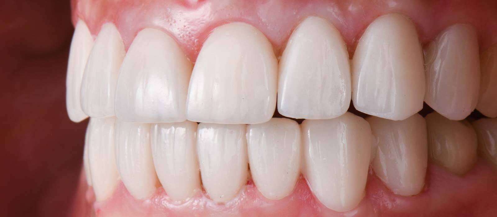 Composite Veneers To Fix Damaged Teeth