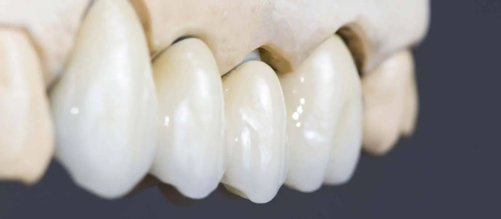 Dental Bridge Permanent Option For Replacing Missing Teeth