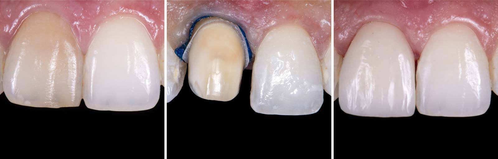 Gold Coast Cosmetic Dentist Tooth Cap Before And After