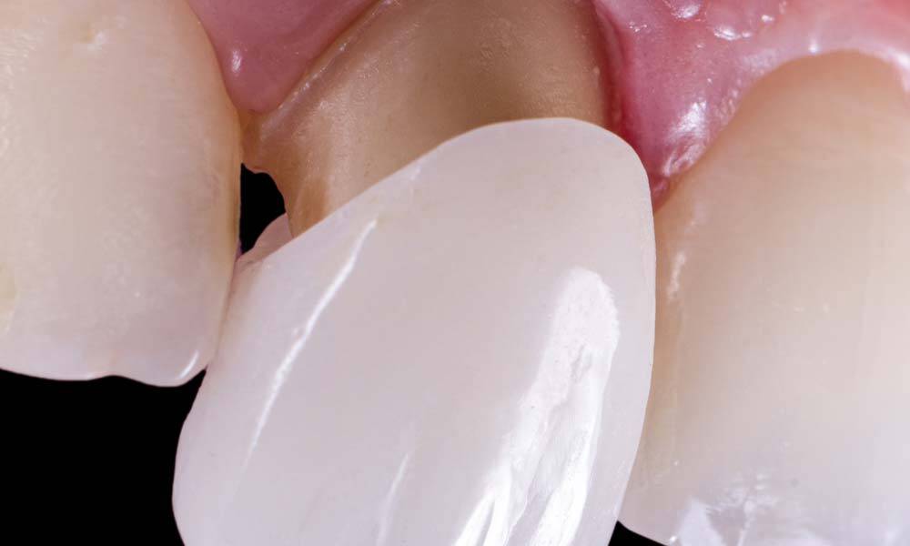 Dental Crowns