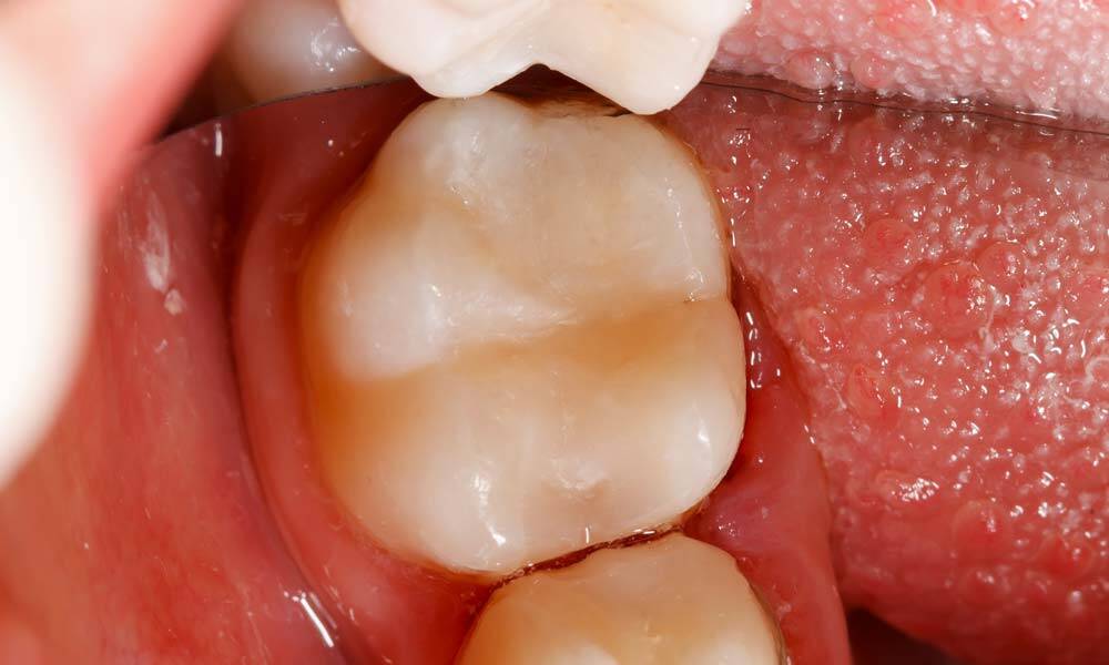 Dental Fillings