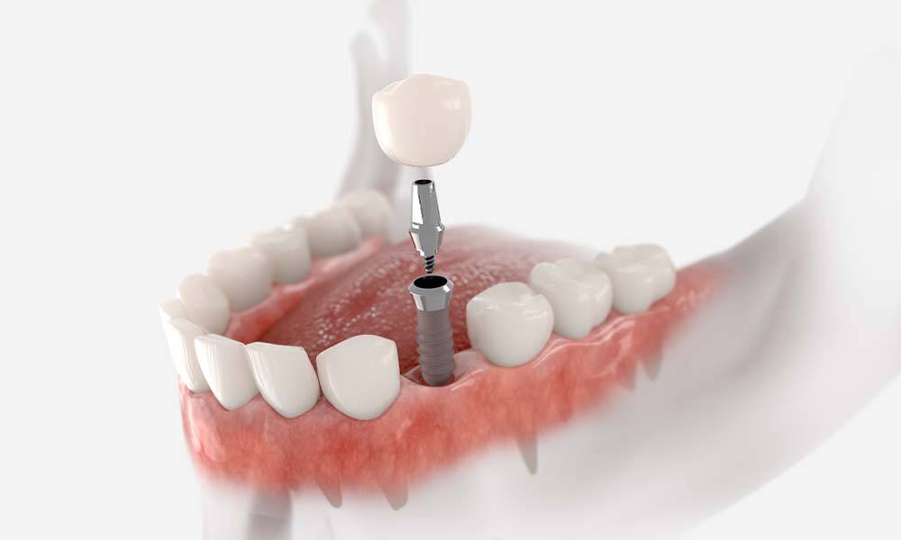 Dental Implant Dentist Near Me