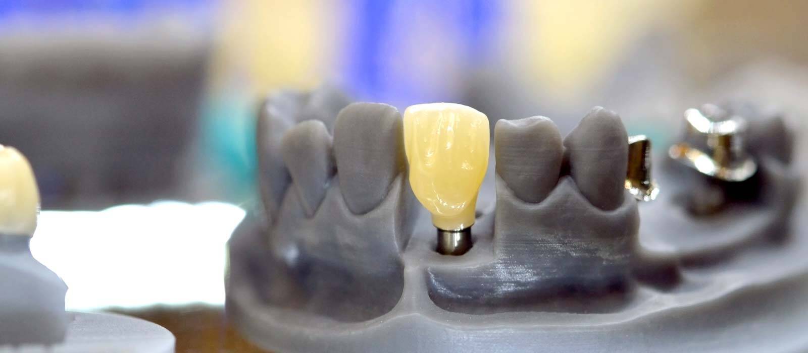 Dental Implant For Decayed Teeth