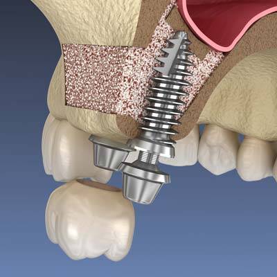 Dental Implant Referrals