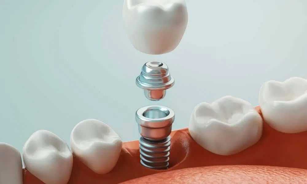 Dental Implant