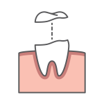 Preparation And Temporary Onlay