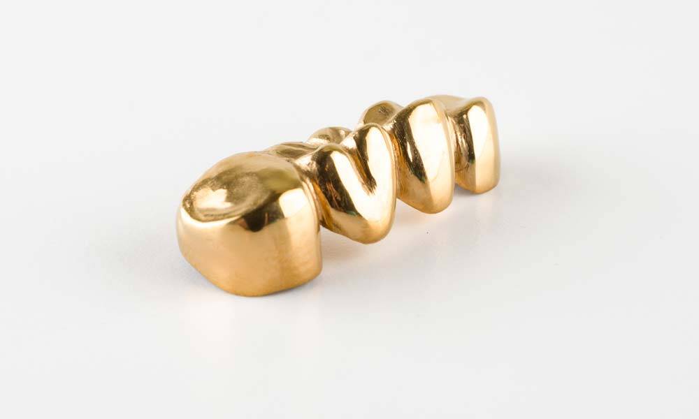 Gold Dental Bridge