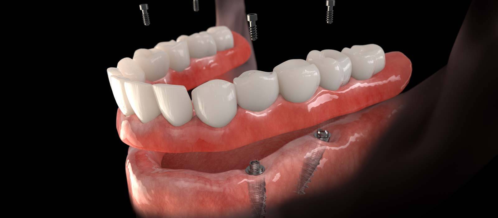 Implant Retained Denture