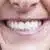 Implant Retained Dentures