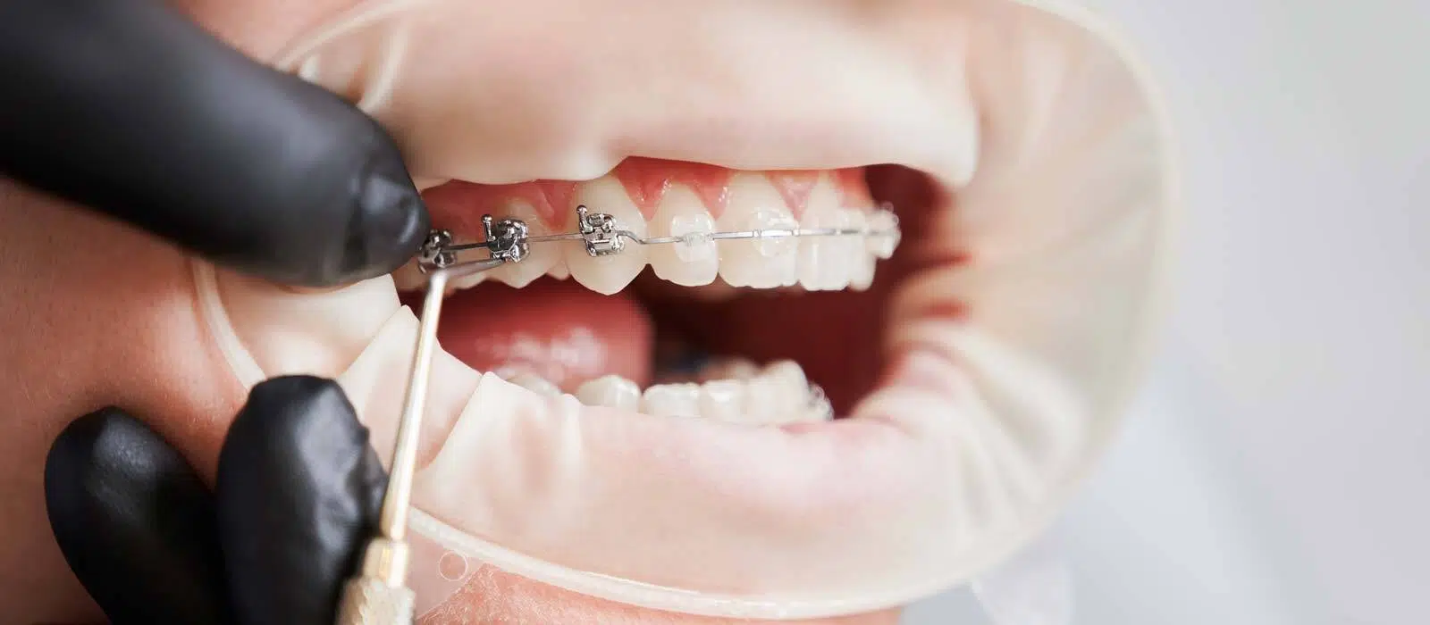 Orthodontics Private Health Insurance