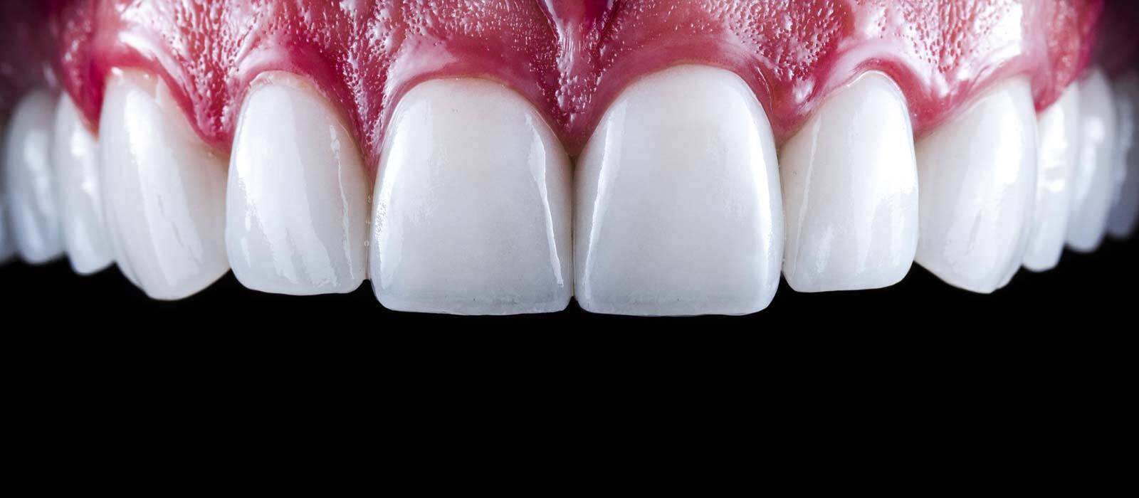 Gold Coast And Brisbane Porcelain Veneers Payment Plans 