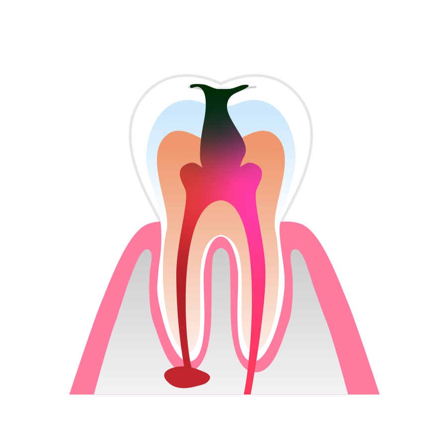 Root Canal Therapy Stage 1