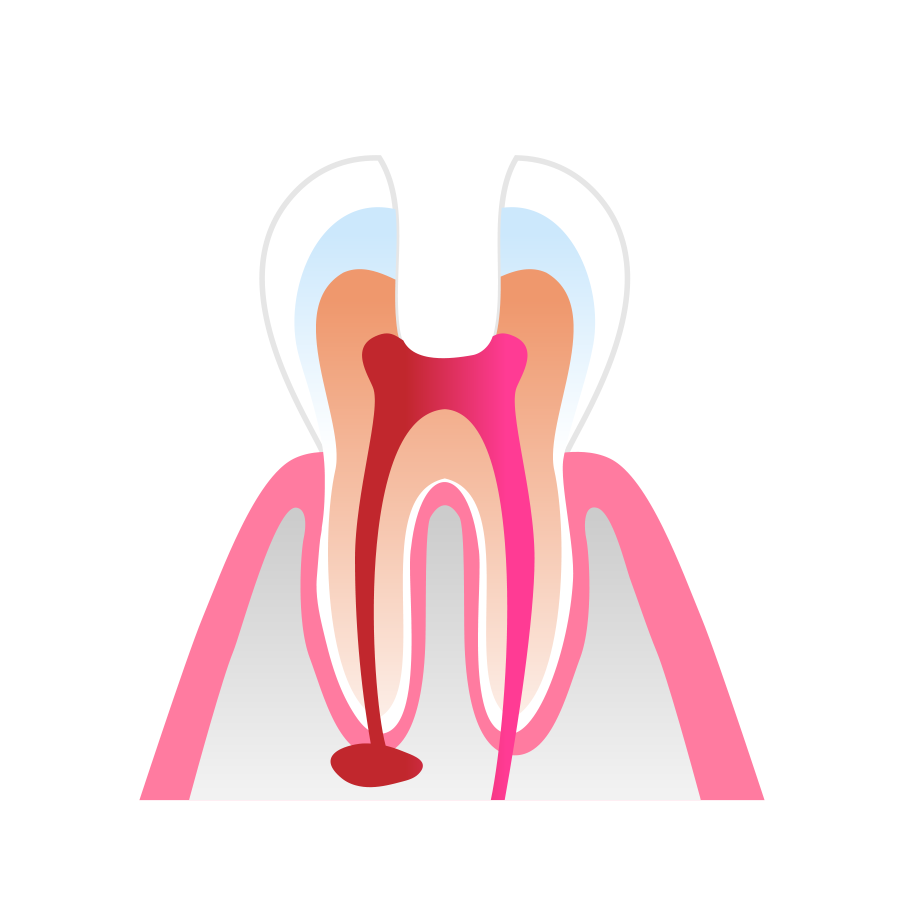 Root Canal Therapy Stage 2