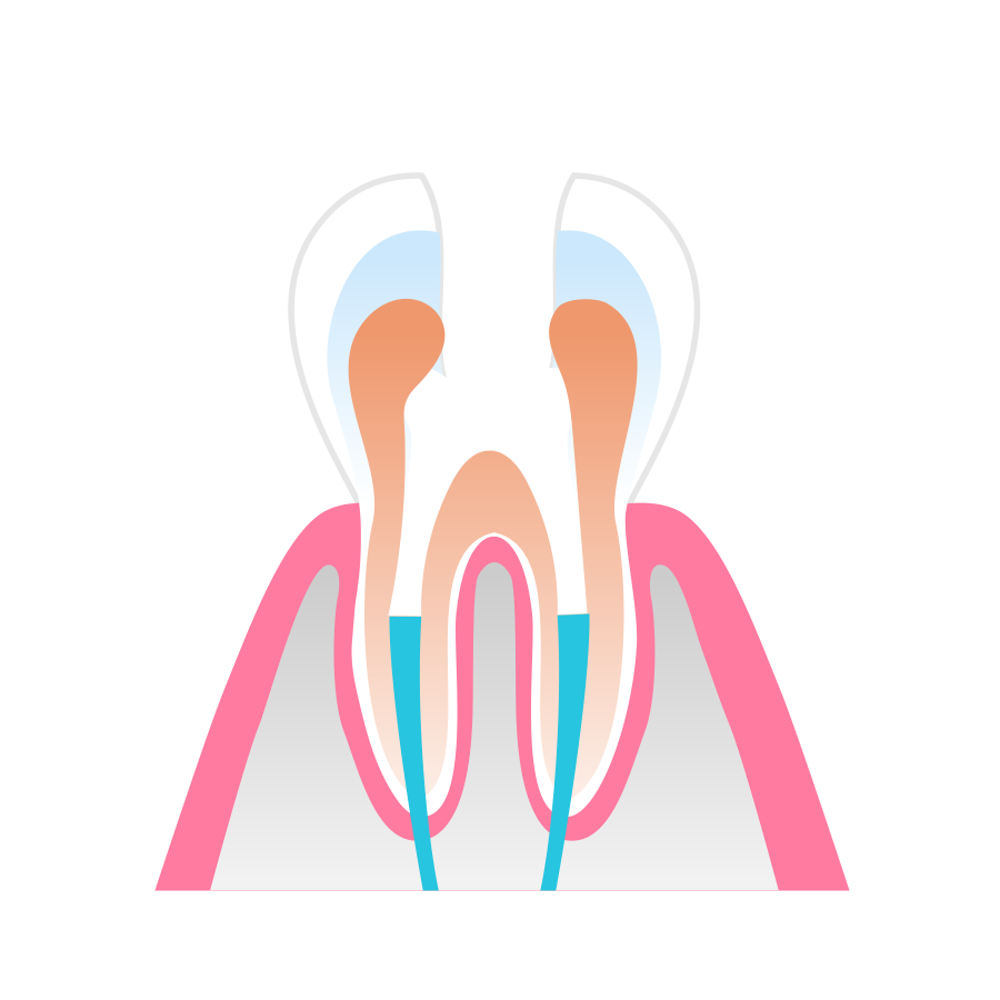 Root Canal Therapy Stage 4