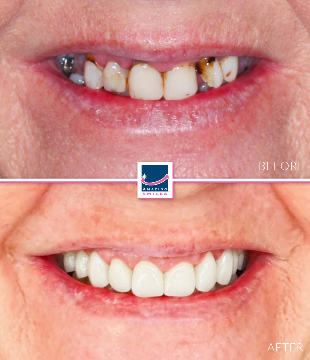 Nerang Dental Case - Before And After