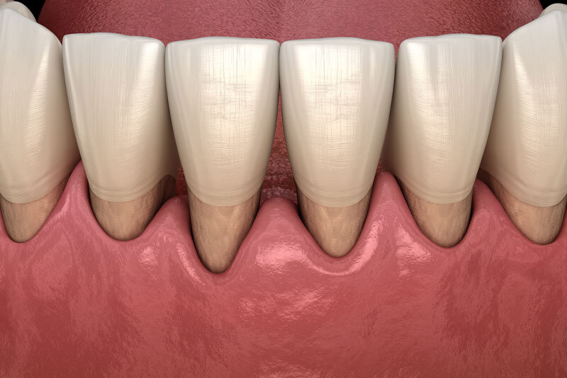 Is Gingival Recession Reversible?