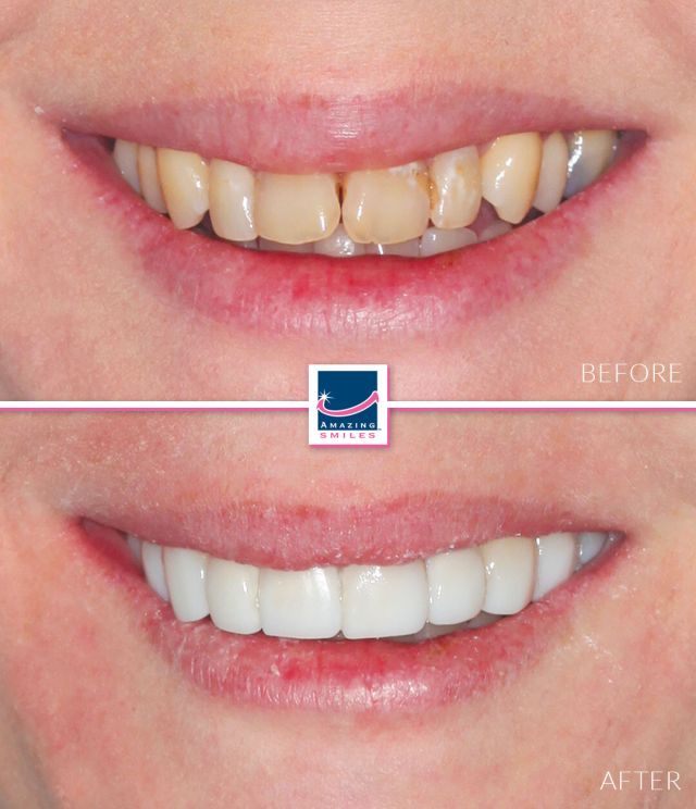 Composite Veneers Gold Coast & Brisbane Free Smile Consult
