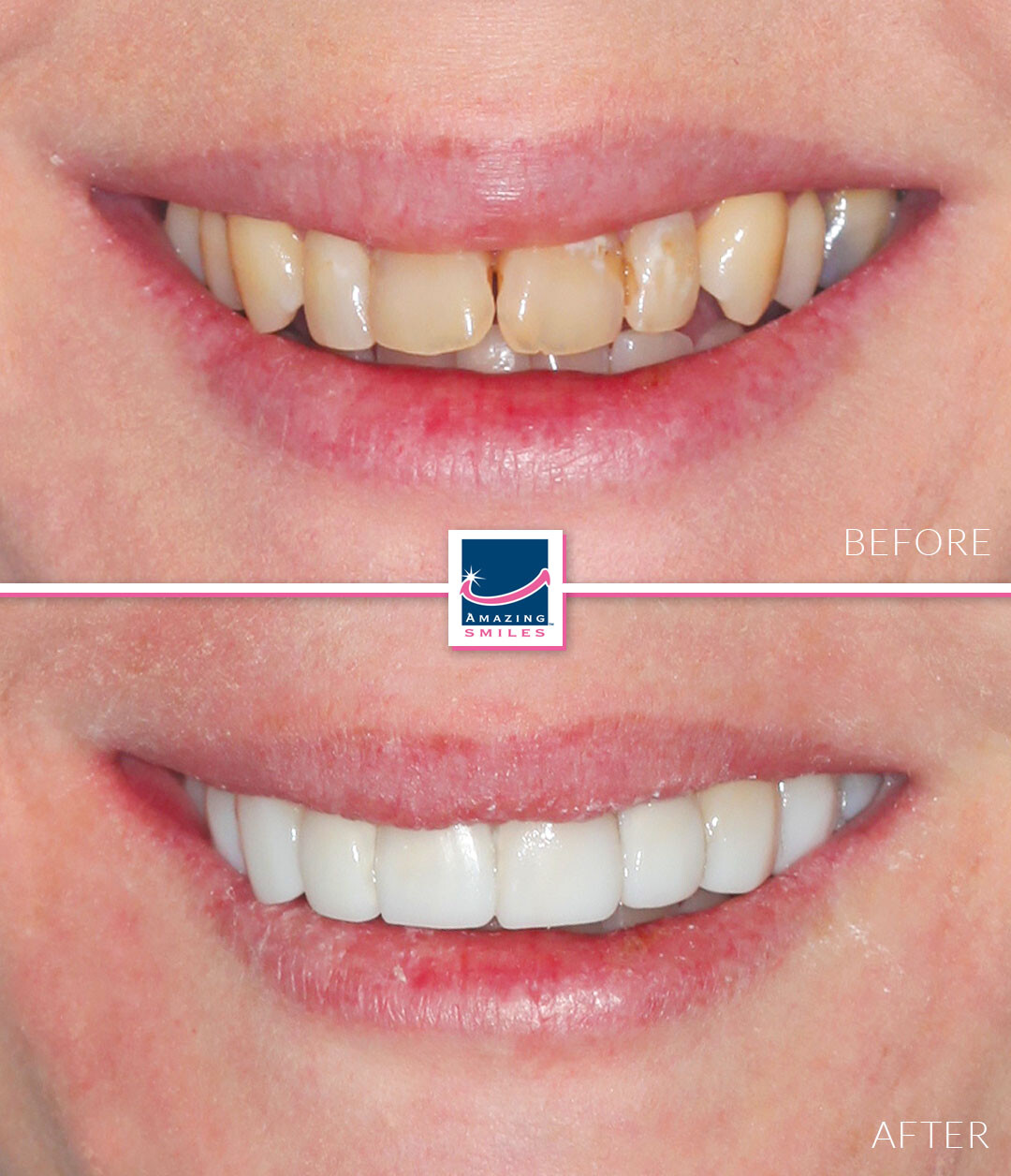 Nerang Dental Case - Before And After