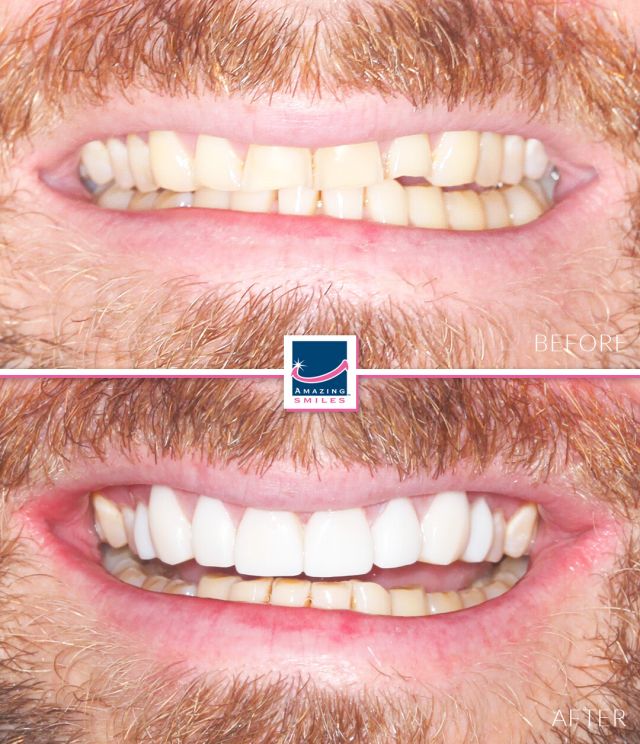 Composite Veneers Gold Coast & Brisbane Free Smile Consult