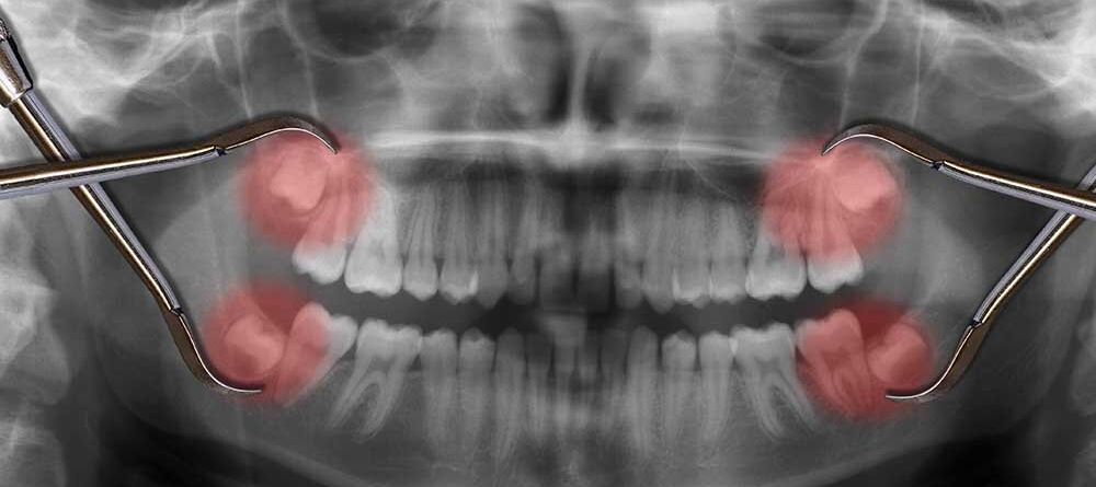The Pros and Cons of Wisdom Teeth Removal