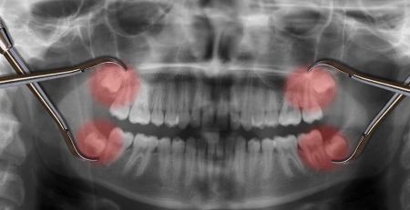 The Pros and Cons of Wisdom Teeth Removal