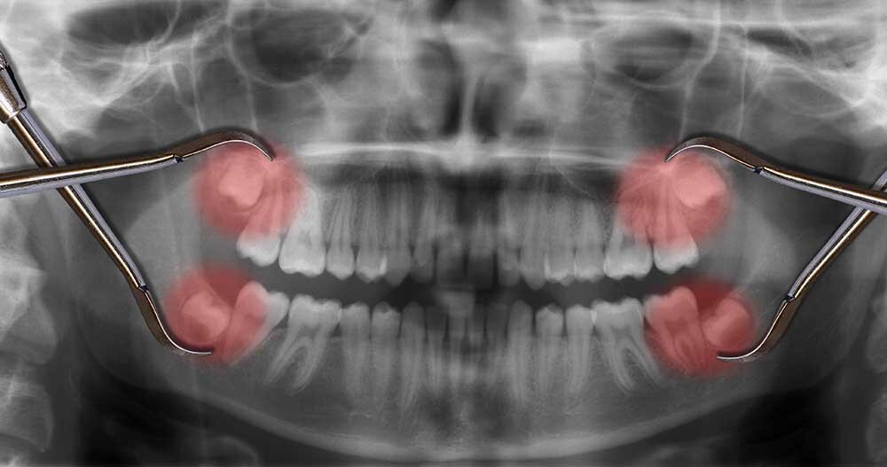 The Pros and Cons of Wisdom Teeth Removal