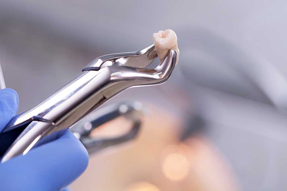 Wisdom Tooth Extractions