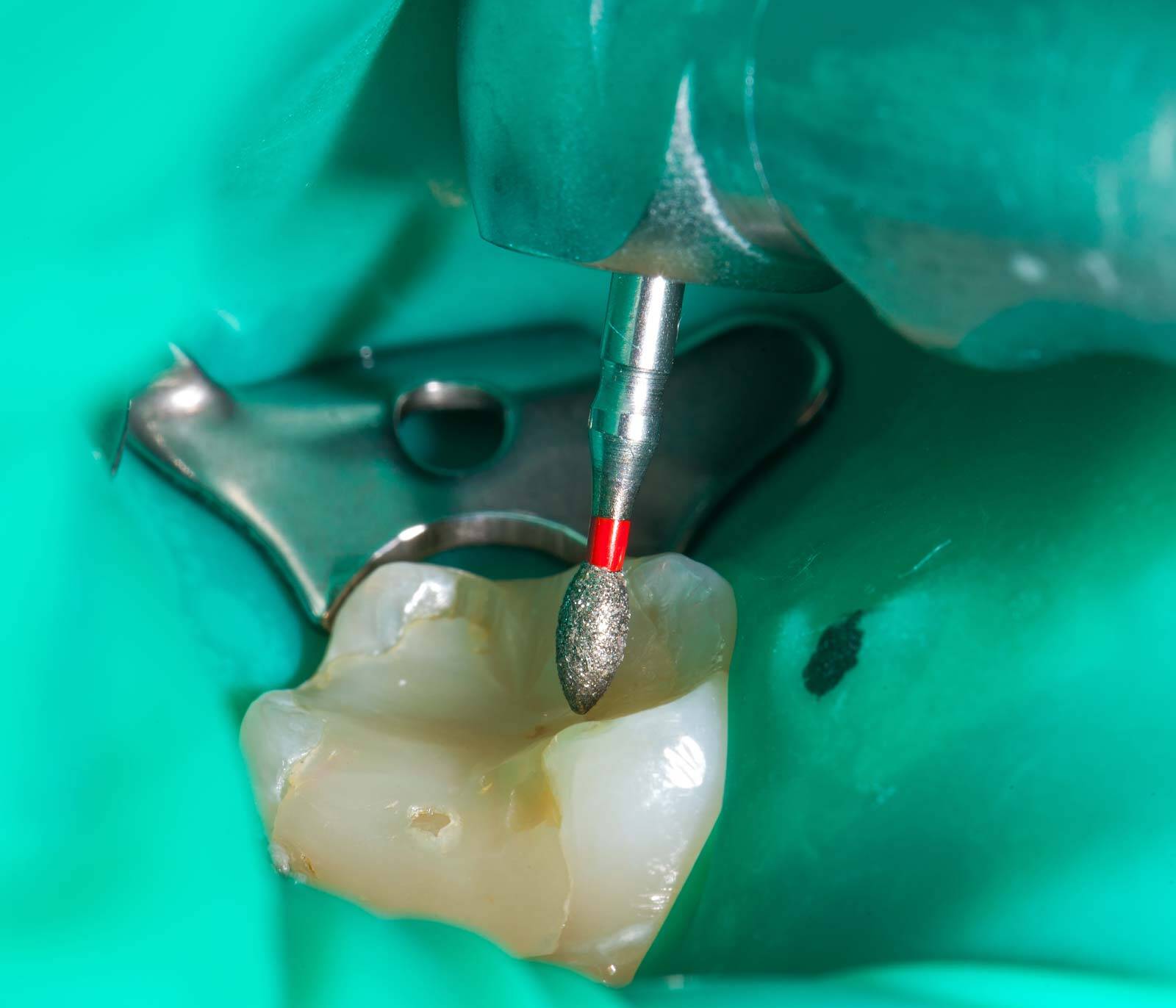 What’s The Difference Between A Root Canal And An Apicoectomy?