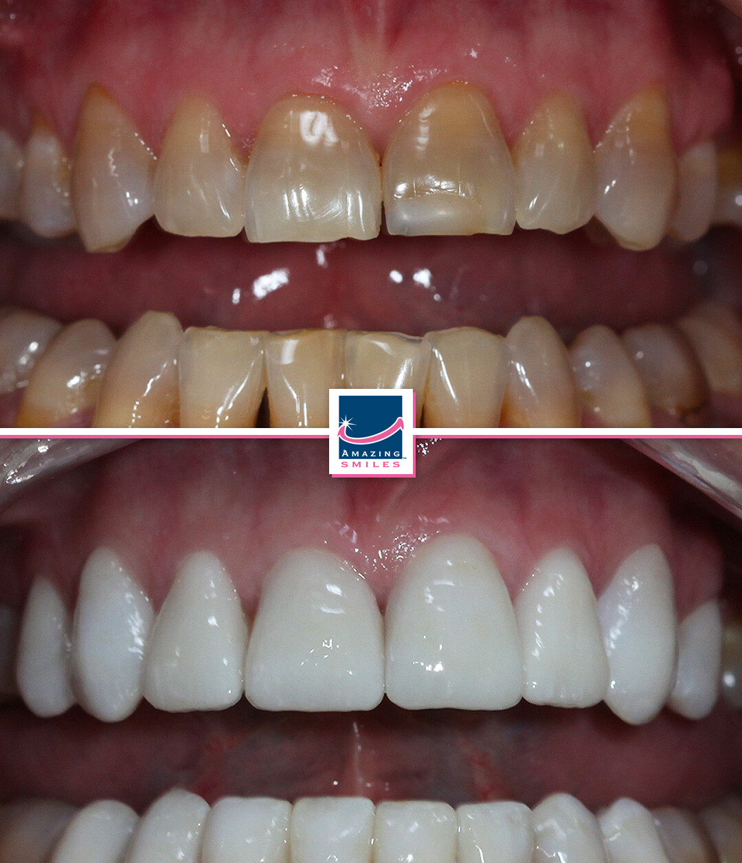 Nerang Dental Case - Before And After