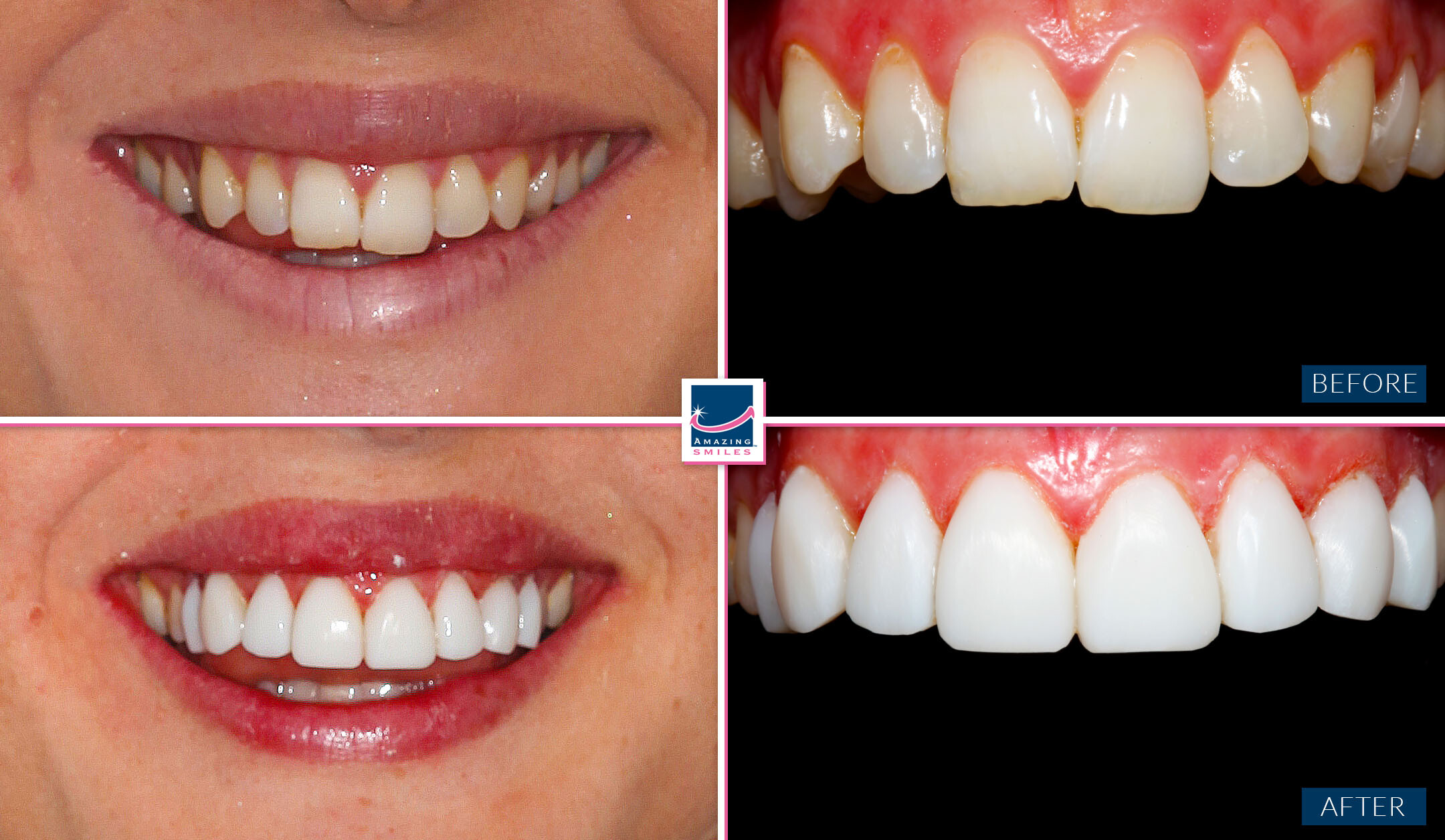 Dental Veneers Gold Coast And Brisbane