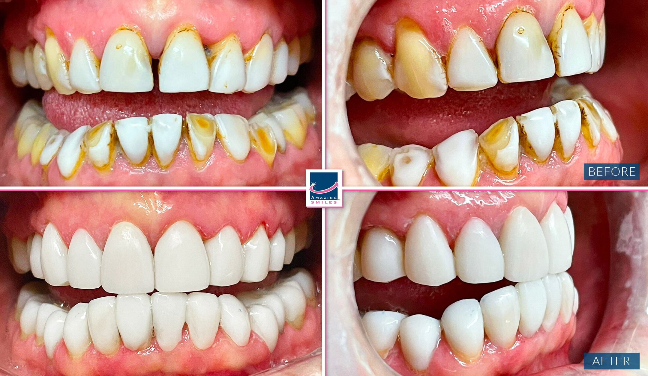 Dental Veneers Gold Coast And Brisbane